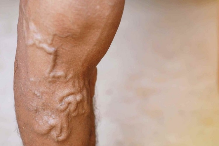 قرص ونوگل بهترین داروی رفع واریس دست و پا 1 کاربرد قرص ونوگل