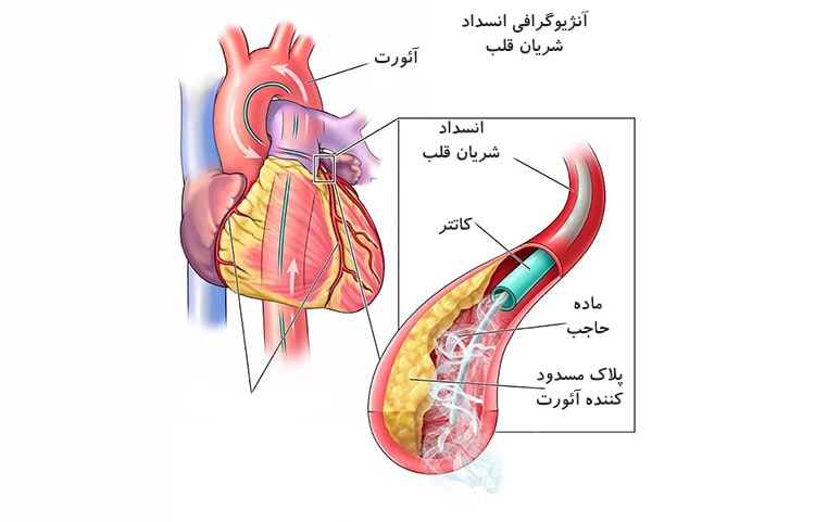 موارد استفاده از آنژیوگرافی قلب