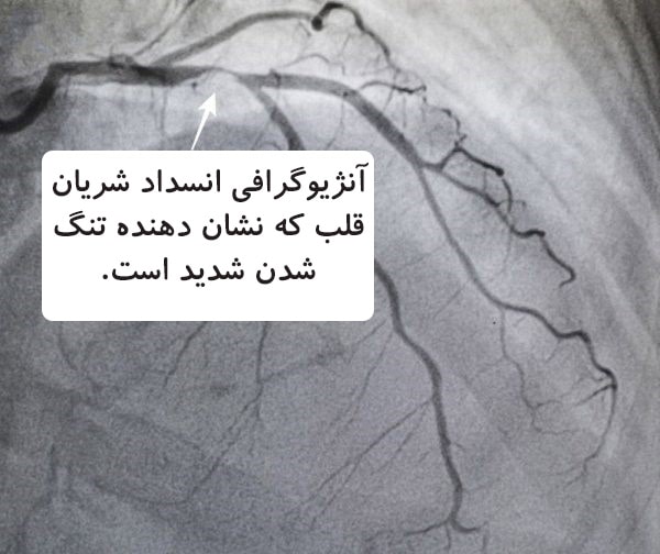نتایج آنژیوگرافی قلب