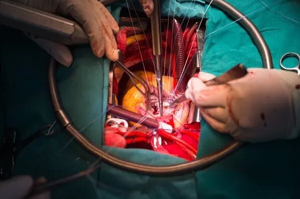جراحی درمان تنگی دریچه میترال