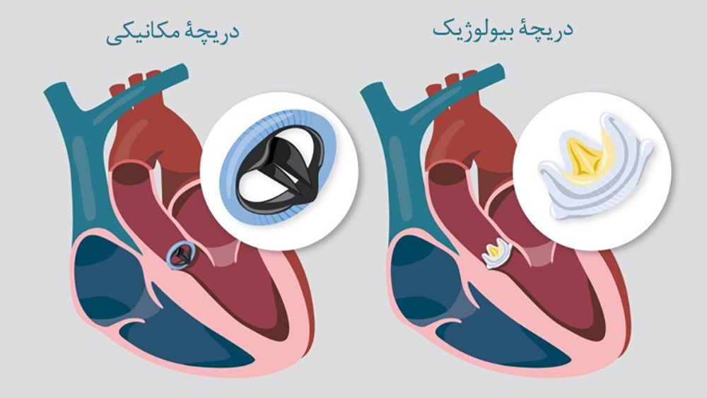 کدام دریچه مصنوعی قلب بهتر است؟