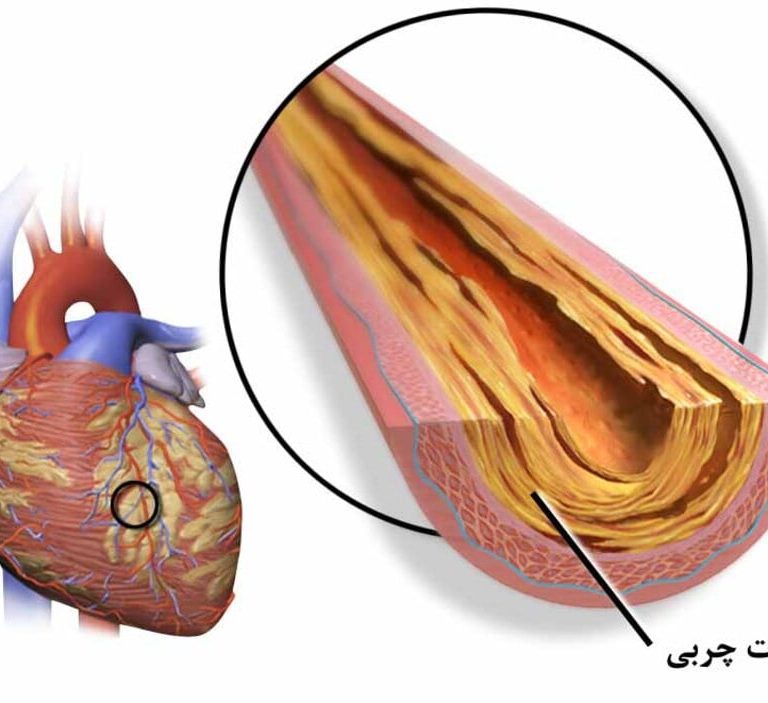 علت گرفتگی رگ قلب و تنگی عروق کرونری چیست؟ بررسی علائم و درمان