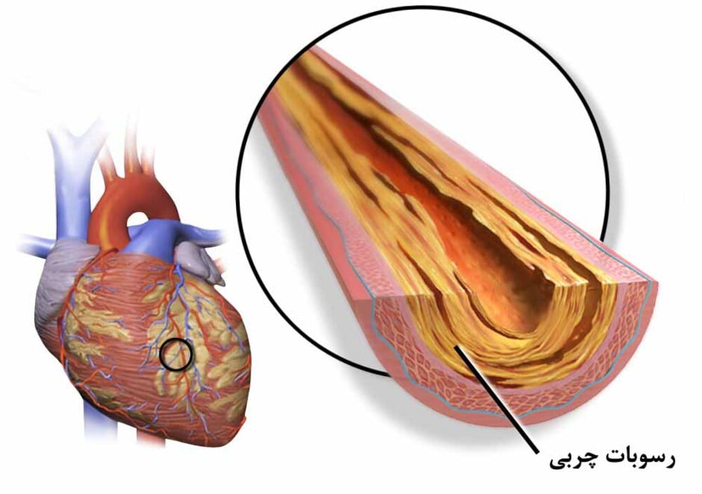 علت گرفتگی رگ قلب و تنگی عروق کرونری چیست؟ بررسی علائم و درمان